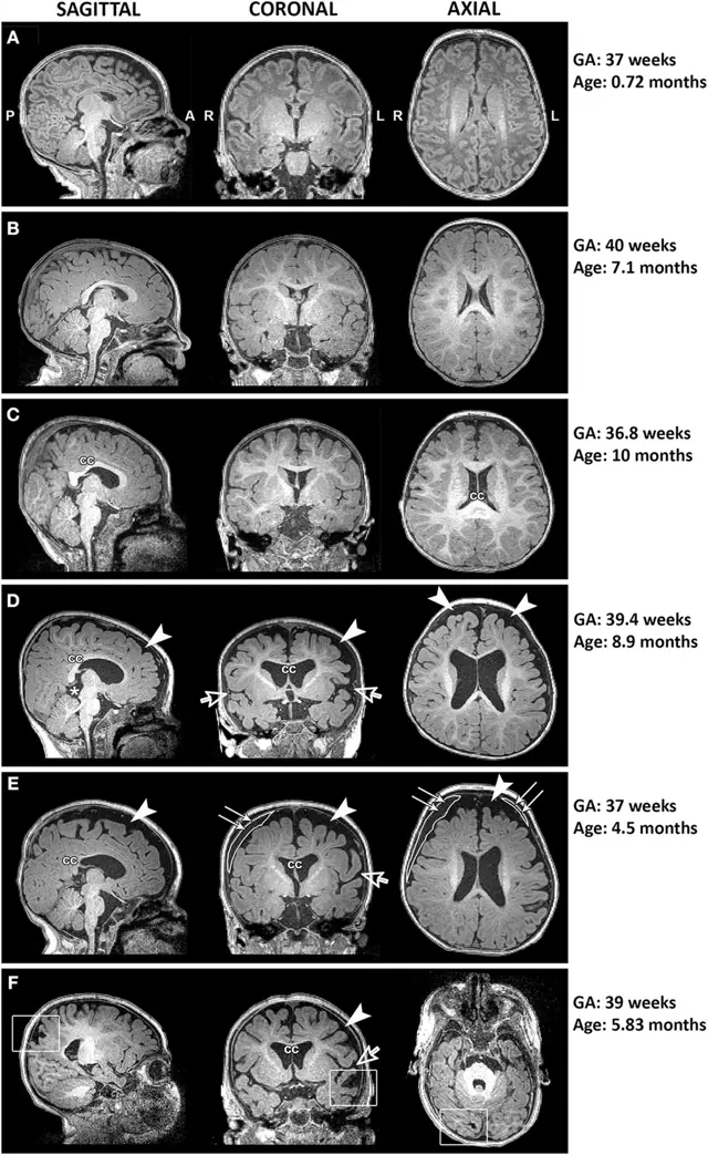 Prancha de ressonância cerebral de lactentes publicada em artigo científico de acesso aberto